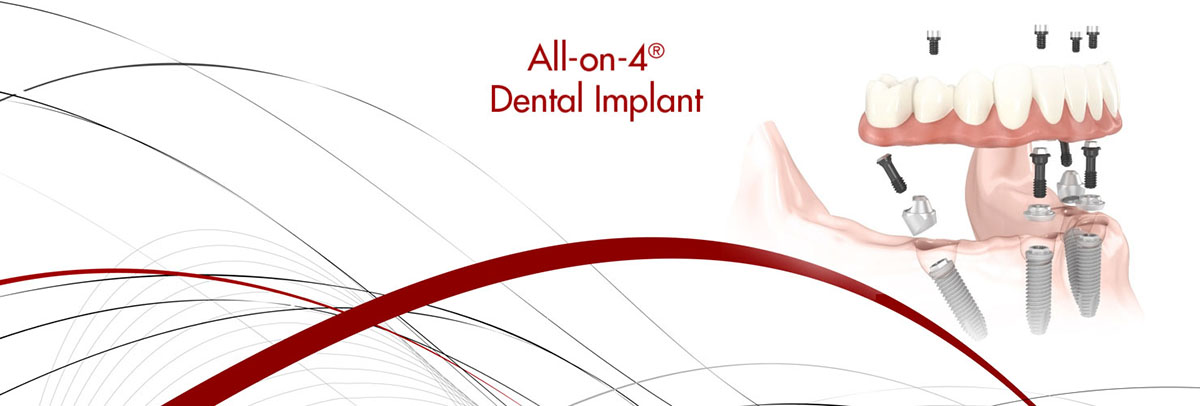 Lindsay All-on-4 Dental Implants