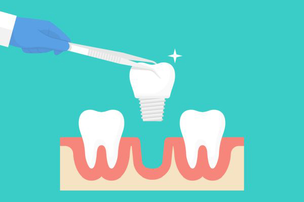 Dental Implants: A Solution For Missing Teeth