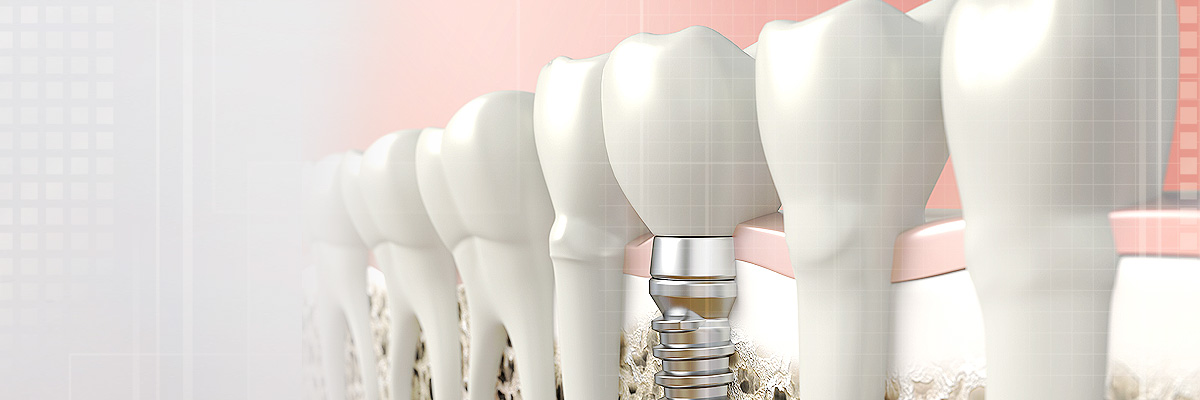 Lindsay Implant Dentist